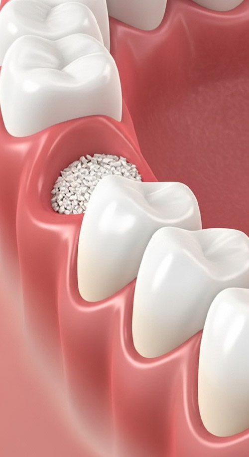 Bone Socket Preservation at Dental Vana