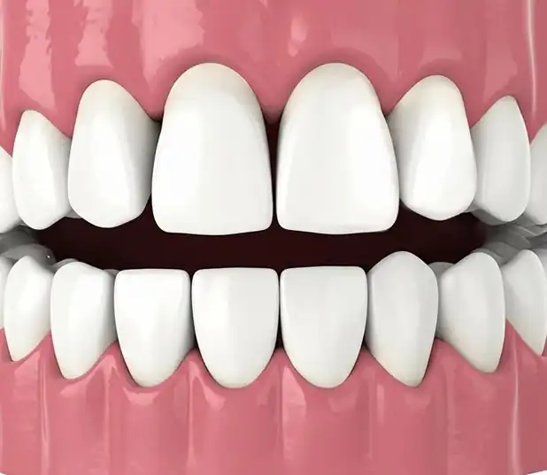Resin Veneers