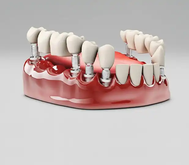 Same day Crowns & Bridges