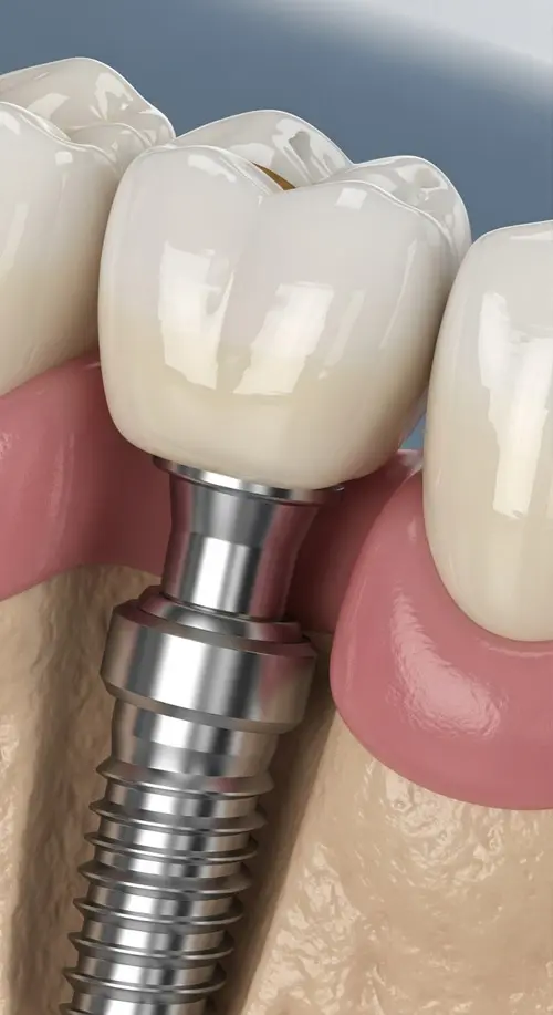Dental Implants