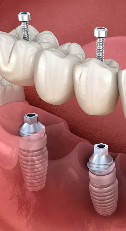Implants Supported Bridges