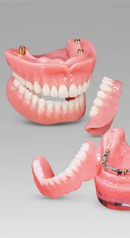 Overdenture