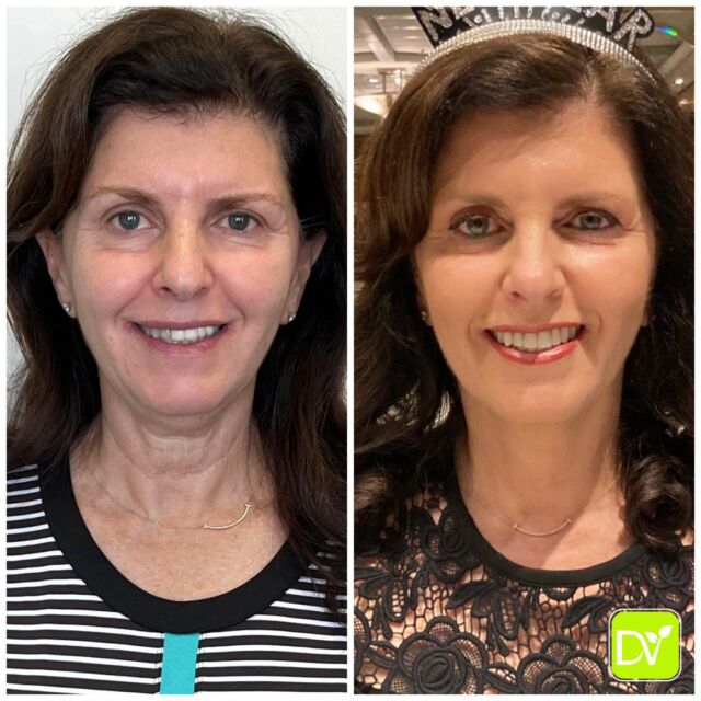 Meet Eileen from New York! 

Referred by a long-time patient, she came to us feeling self-conscious about her smile. Eileen was shy to smile because one side of her teeth looked different—darker and more set back than the other. She dreamed of having a smile that made her feel confident and radiant.

✨ After her smile makeover with us, Eileen now has a fuller, brighter, and more balanced smile! She's smiling bigger than ever and truly living her best life. She even sent us this beautiful picture with the words, "You changed my life! I never realized how powerful a big smile can make you feel!" 

Witnessing transformations like Eileen’s reminds us why we love what we do—creating smiles that light up lives! 💫

#SmileMakeover #CosmeticDentistry #ConfidentSmile #SmileTransformation #MiamiSmiles #DentalCareJourney #BeforeAndAfterSmile