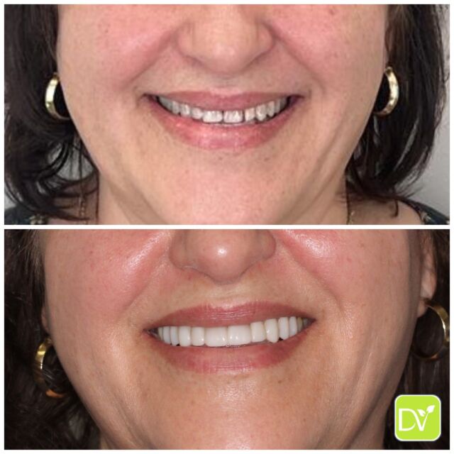 ✨ Achieve a Natural, Brighter Smile with Resin Veneers at Dentalvana! ✨

Say goodbye to gaps and hello to a balanced, beautiful smile with our non-invasive resin veneers! 

At Dentalvana, we carefully add composite material on top of your teeth without altering their natural structure. This approach allows us to close spaces, enhance facial harmony, and give you a brighter, more confident smile! 

Ready to elevate your smile game in Miami? Let’s talk about how resin veneers can be the perfect solution for you! Book your consultation today and discover the art of a natural-looking smile! 

👉 DM us now or call +1 786-516-2882 to book your appointment!

#Dentalvana  #MiamiCosmeticDentist #MiamiResinVeneers #SmileMakeover #NonInvasiveSmile #MiamiTeethTransformation #DentalHealthMiami