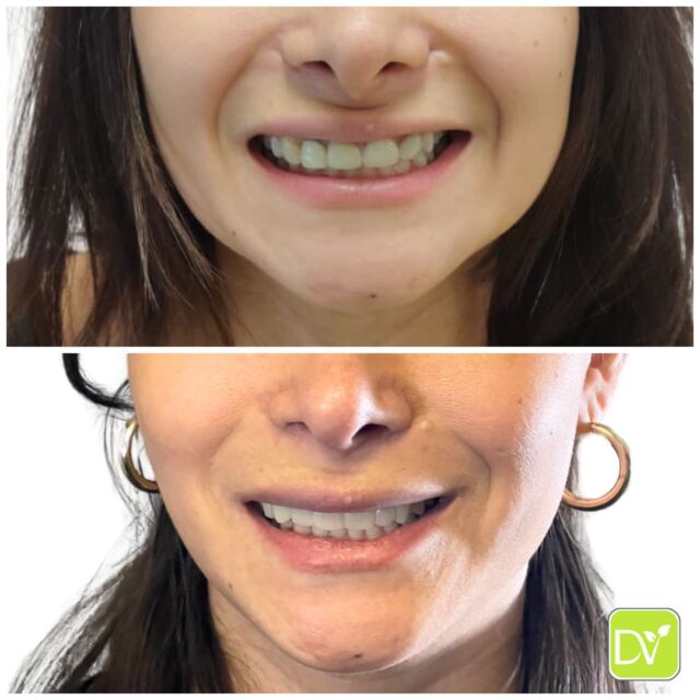 ✨ Transforming Smiles, Boosting Confidence ✨

Our beautiful client came to us feeling unhappy with the disproportionate look of her teeth.

They appeared too wide and short for her liking. This complex case involved missing teeth, old crowns, and gums in the wrong place.

We took a holistic approach and applied full upper veneers, from molar to molar, to open her bite and restore the proper length of her teeth. 

The result? A naturally balanced, youthful smile and a more comfortable bite. 😁✨

Ready to achieve the smile you’ve always dreamed of?

📲 DM us or call (786) 516-2882 for a consultation today!

#SmileMakeoverMiami #CosmeticDentistMiami #VeneersTransformation #YouthfulSmile #DentalVeneers