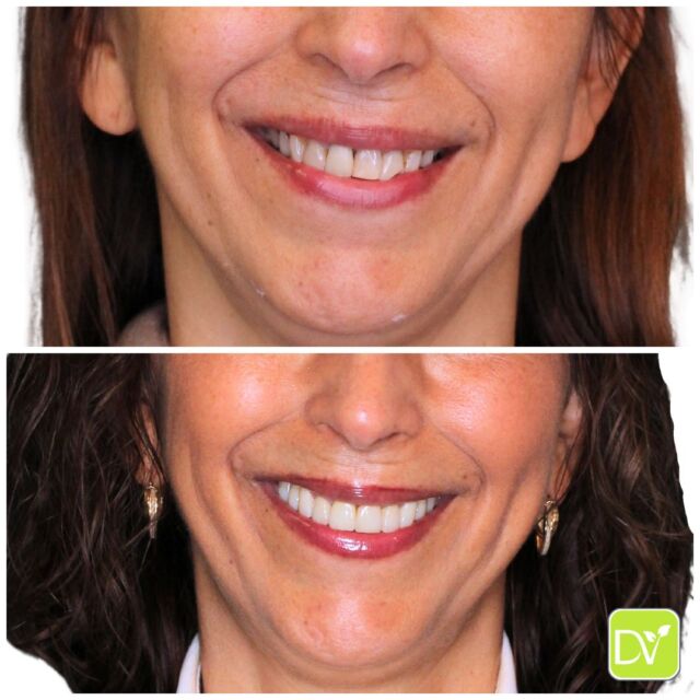 Her goal was a stunning smile transformation!

She felt self-conscious about her teeth and knew she needed extensive work, including replacing missing back teeth. Our solution? 

A customized smile design for her upper teeth, bringing back both function and aesthetics. The result? 

A confident, beautiful smile she can’t stop sharing! 😁💫

Ready to start your smile journey? Book a consultation today (786) 516-2882.

#SmileMakeover #CosmeticDentistMiami #DentalTransformation
#SmileDesign #TeethWhitening #DentalAesthetics #ConfidentSmile