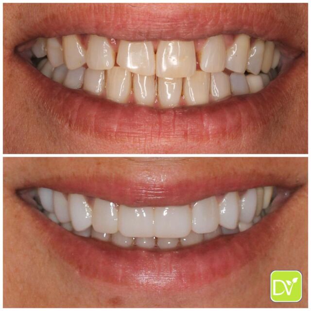 Resin veneers offer a flawless, natural look that enhances your unique features. 

Perfect for anyone looking to elevate their smile with a quick and affordable solution! 😁 

Transform your teeth and boost your confidence in just a few appointments. 

Ready for that picture-perfect smile? DM us today to book your consultation and start your journey to a stunning new smile! 💫 

#ResinVeneers #PicturePerfectSmile #SmileTransformation #CosmeticDentistry #ConfidentSmile #VeneersMiami #SmileMakeover