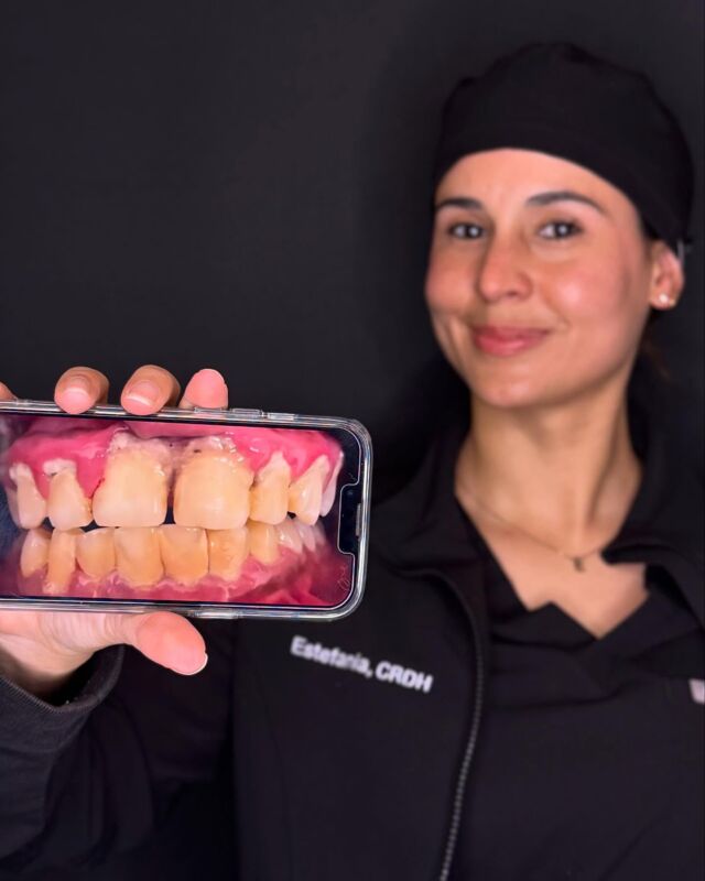 Look how easy is to improve your oral health by just having a professional dental cleaning!! ✨
A professional dental cleaning not only brightens your smile but also improves your overall health by preventing gum disease and cavities.